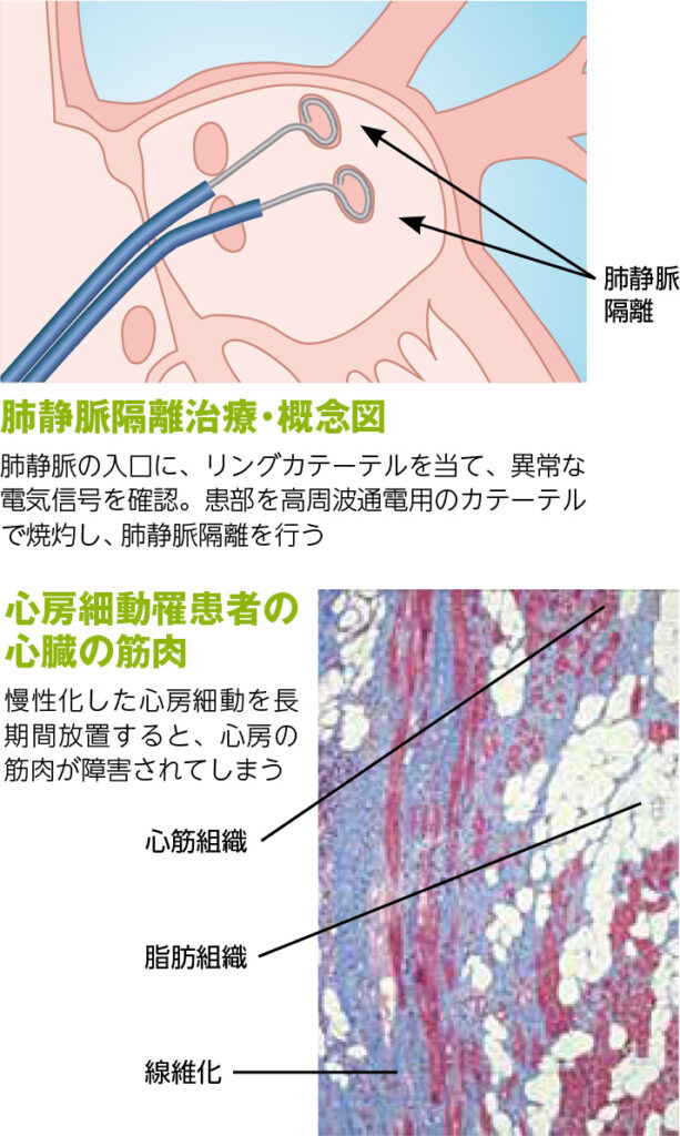 心房細動」を治すカテーテルアブレーション | IMS情報局