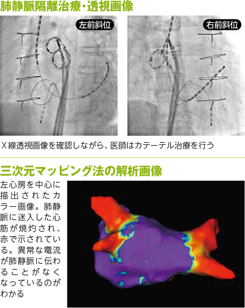 心房細動」を治すカテーテルアブレーション | IMS情報局